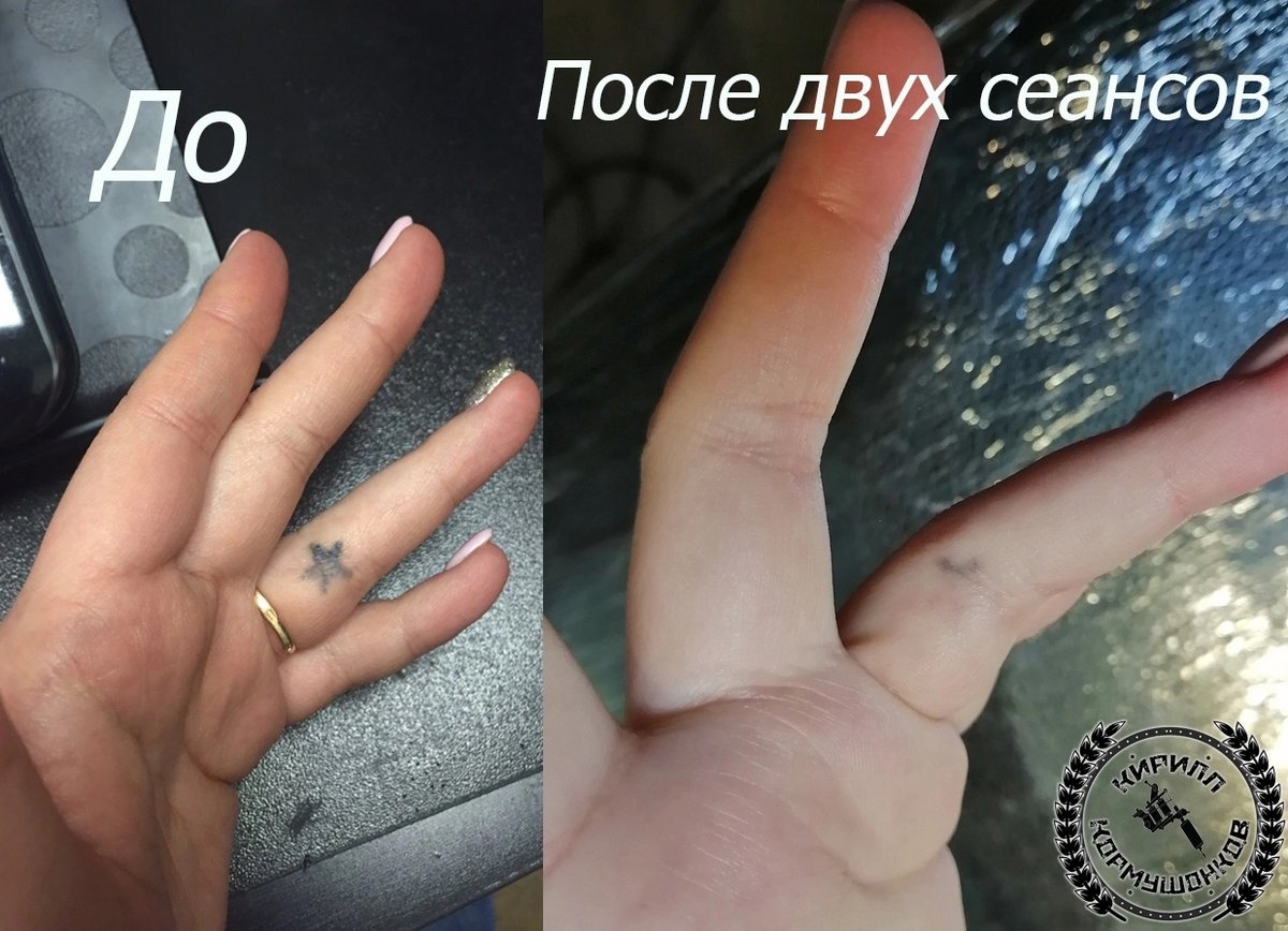 Татуировка по шрамам и растяжкам: как рисунок помогает принять тело