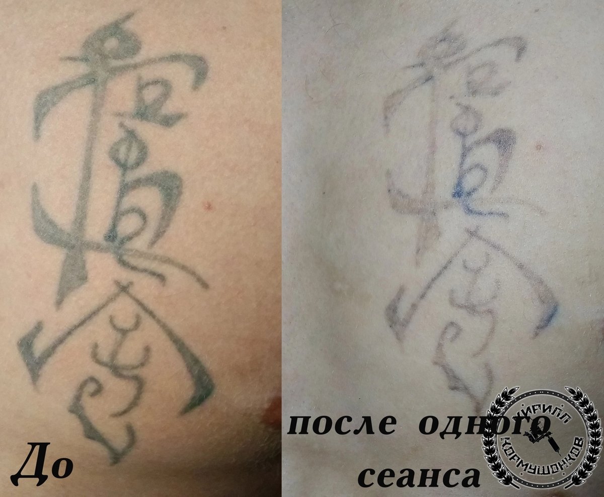 Удаление татуажа лазером в Нижнем Новгороде: цена и сеансы